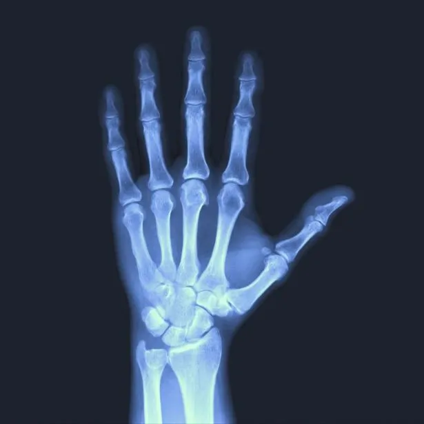 Radiografia mano presso lo studio del chirurgo della mano a Foggia Roberto Gabrieli